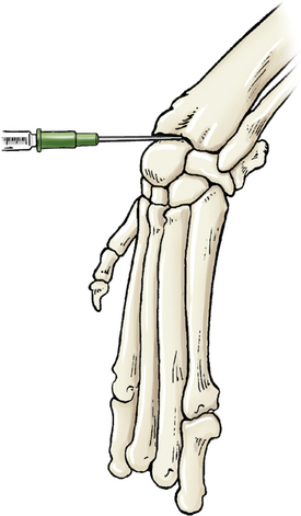 Arthrocentesis